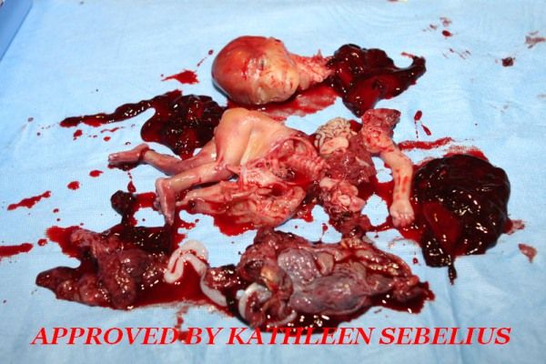  photo Abortion-20weeks_sebelius_zps796ba010.jpg